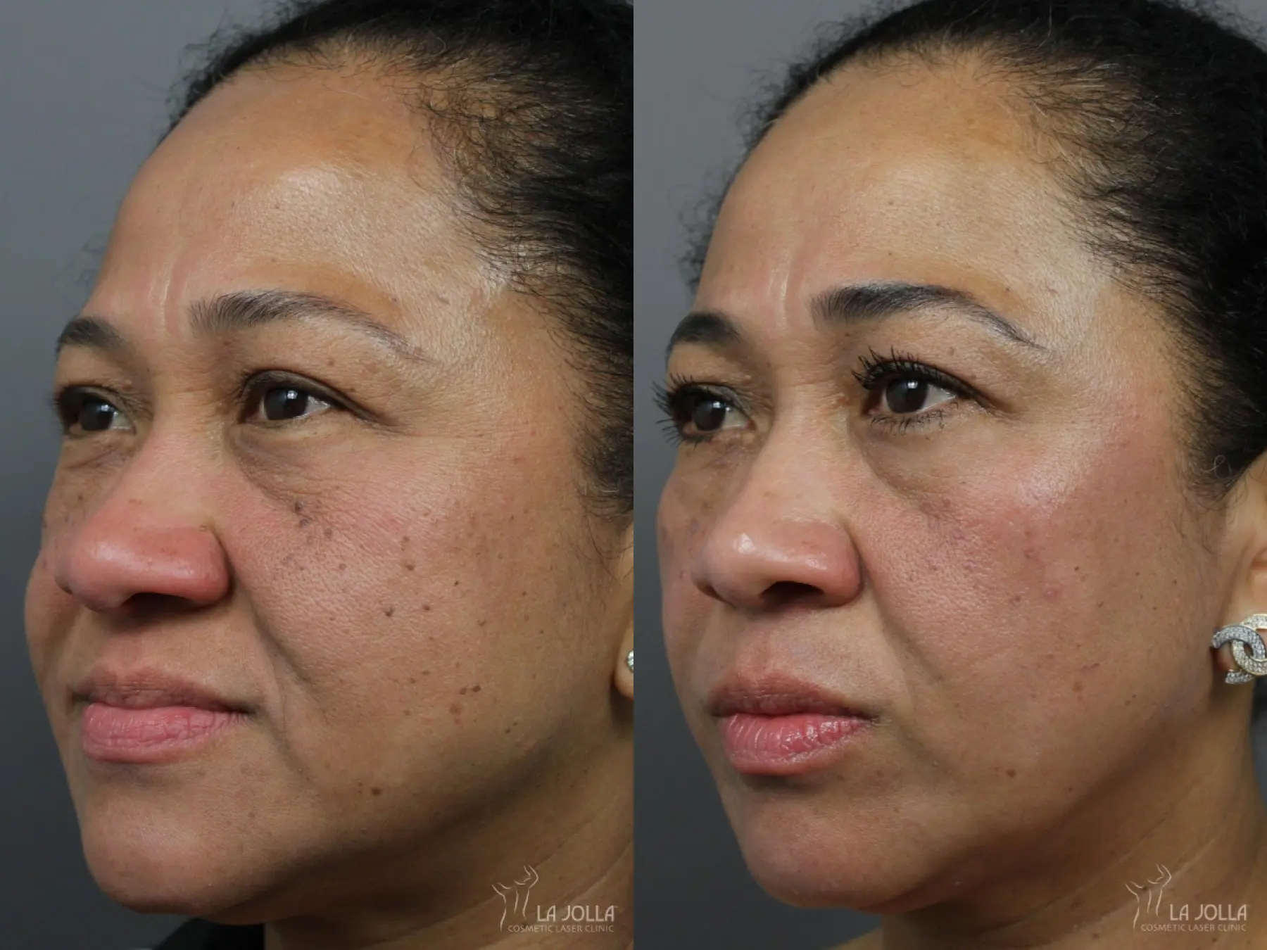 Fraxel®: Patient 10 - Before and After 1
