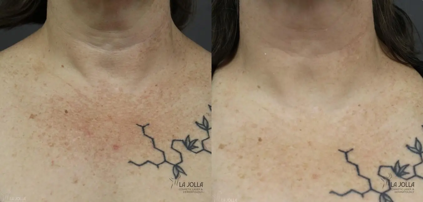 Fraxel®: Patient 3 - Before and After 2