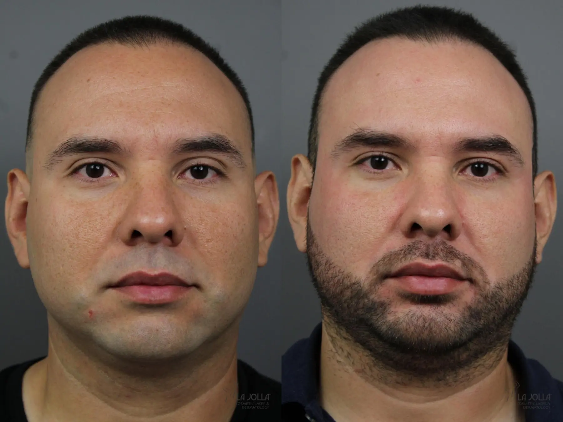 Fraxel®: Patient 3 - Before and After 1