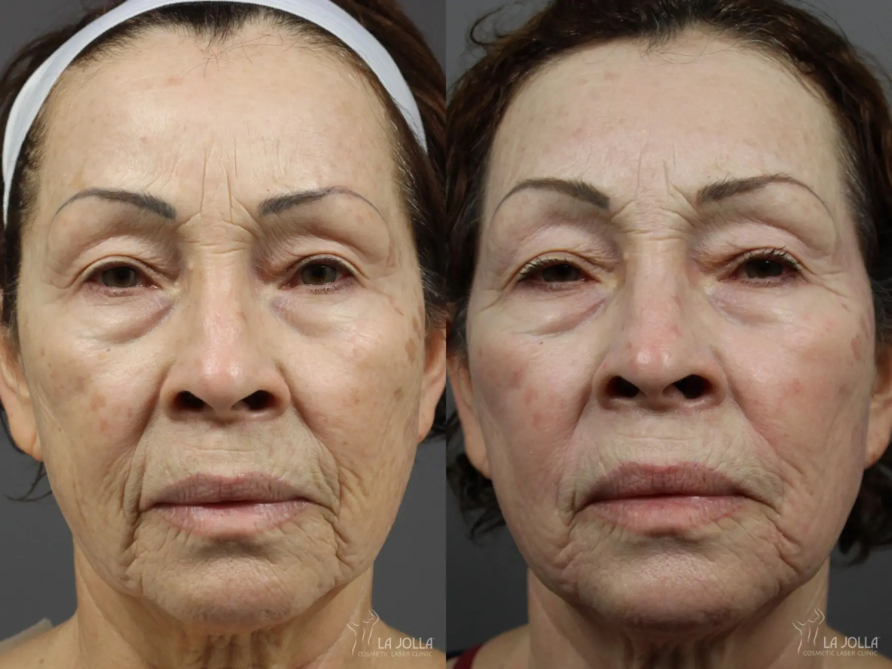 Fraxel®: Patient 8 - Before and After 2