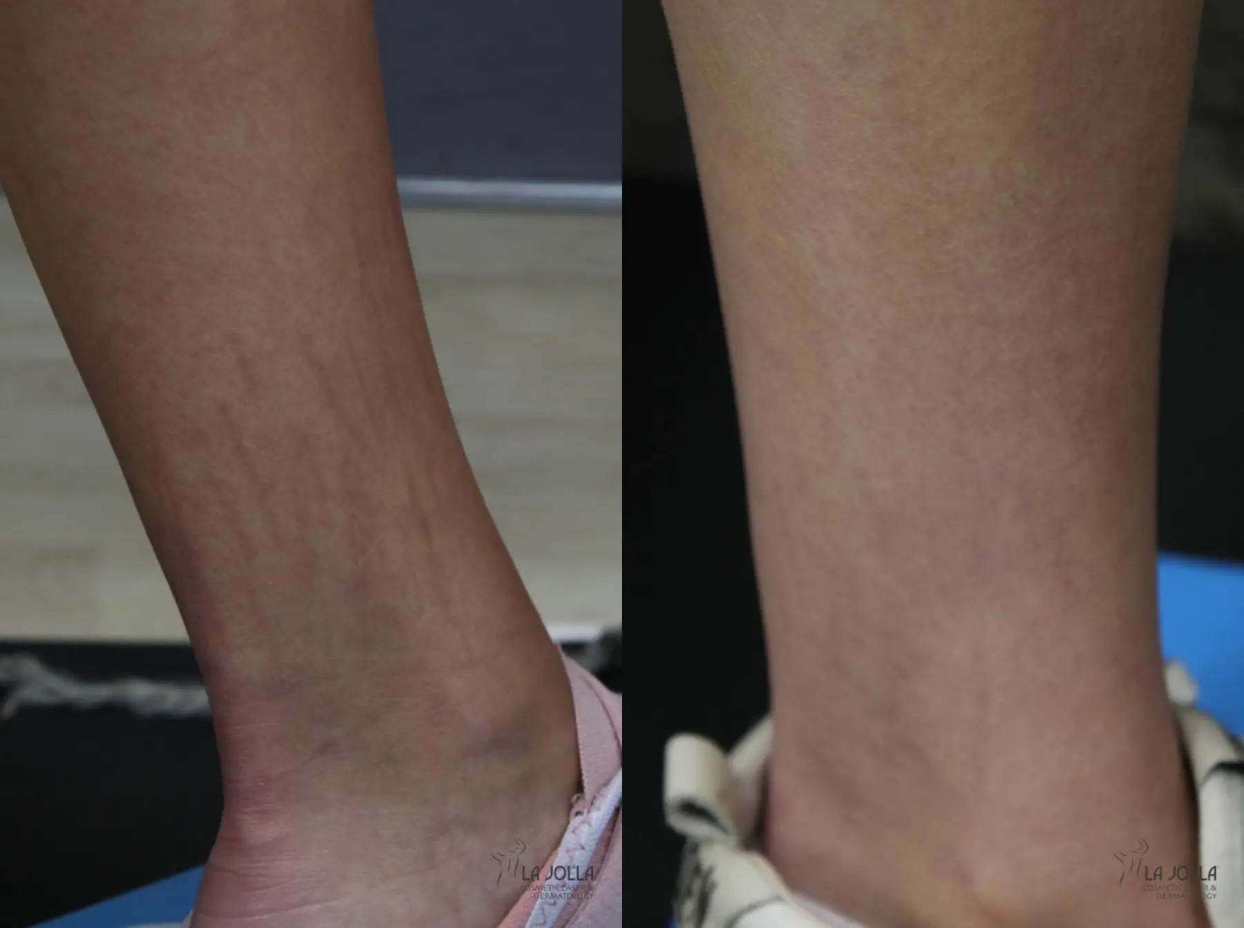 Fraxel®: Patient 1 - Before and After 1