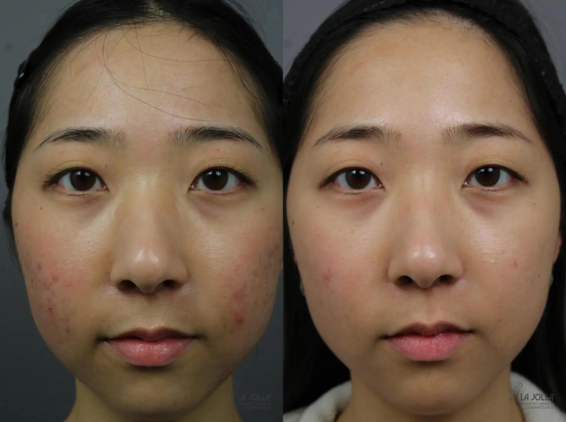 Fraxel®: Patient 1 - Before and After  