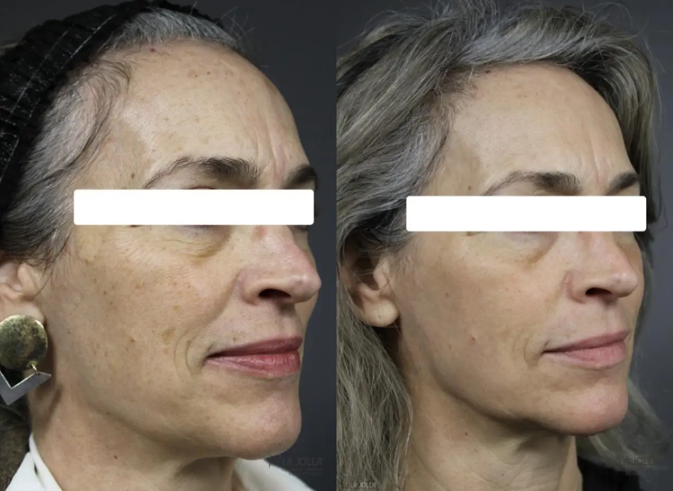 Fraxel®: Patient 1 - Before and After 2