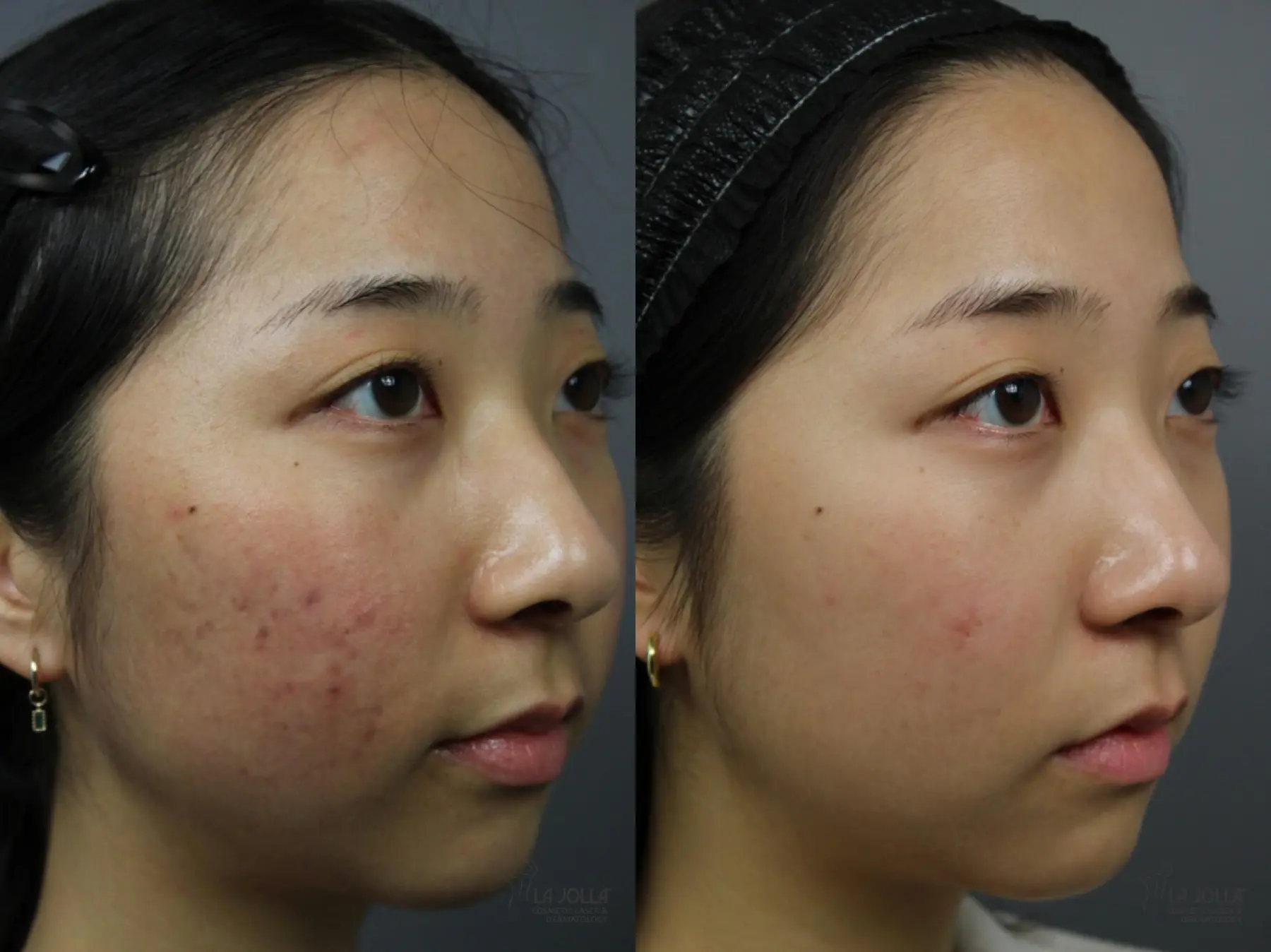 Fraxel®: Patient 2 - Before and After 3