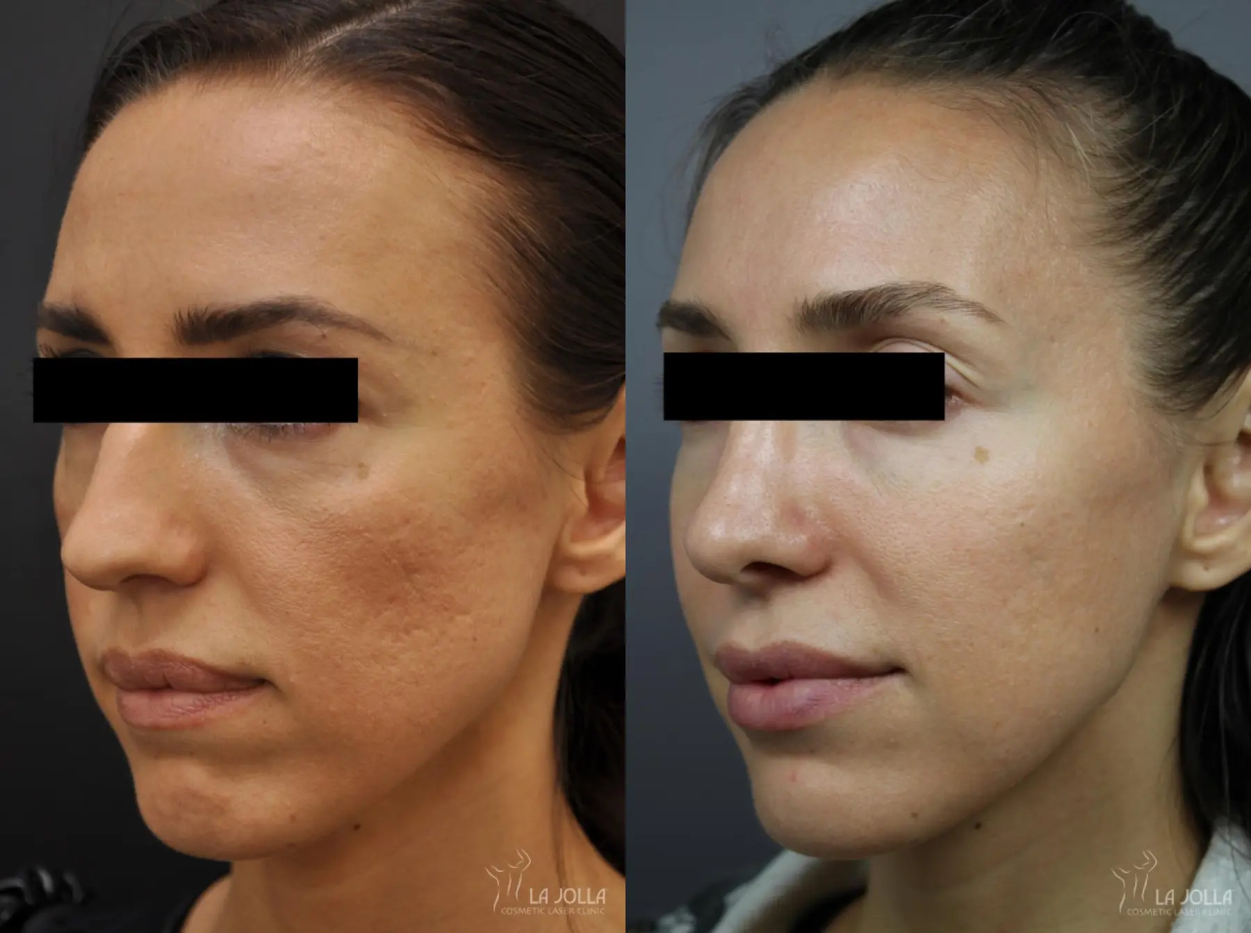Fraxel®: Patient 14 - Before and After 1