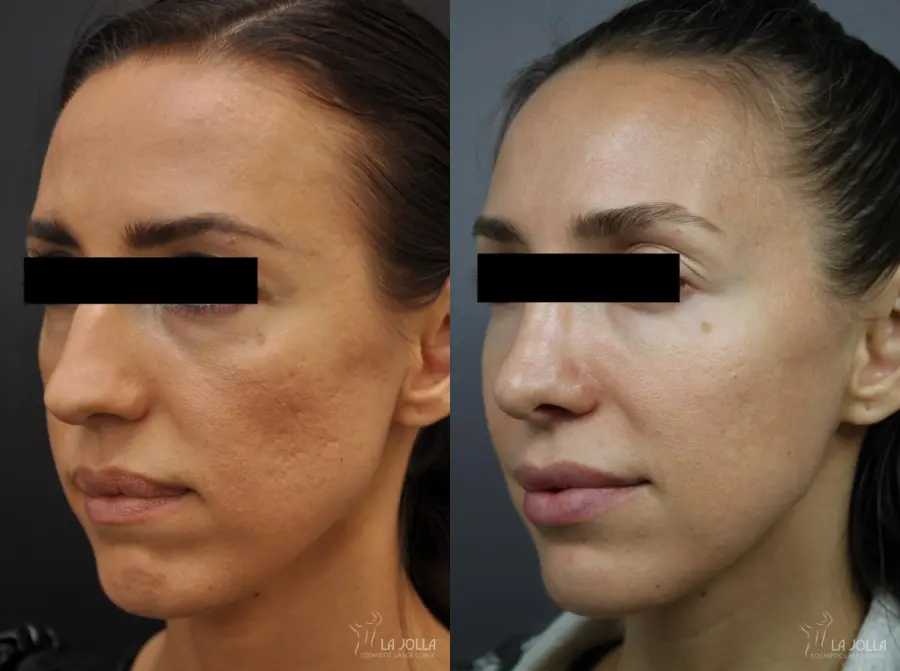 Fraxel®: Patient 9 - Before and After  