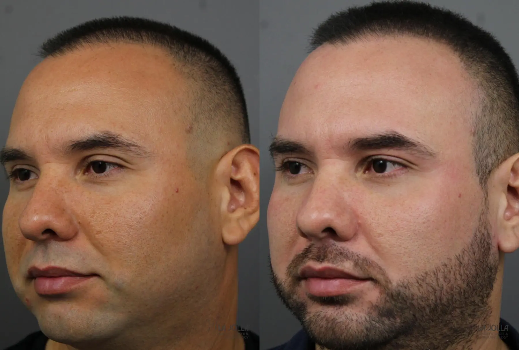 Fraxel®: Patient 3 - Before and After 2