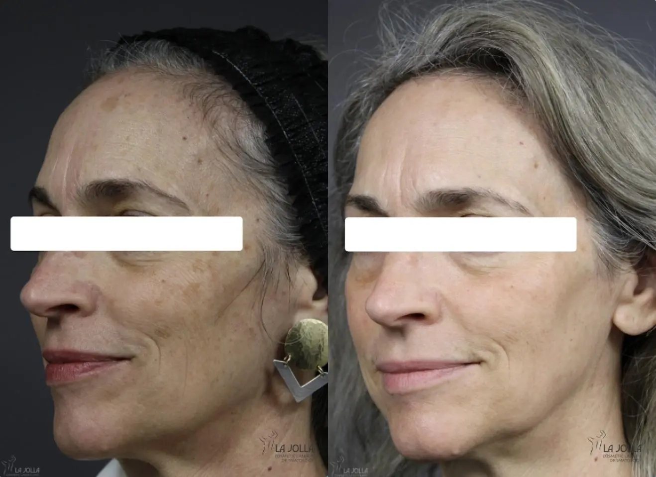 Fraxel®: Patient 1 - Before and After 3