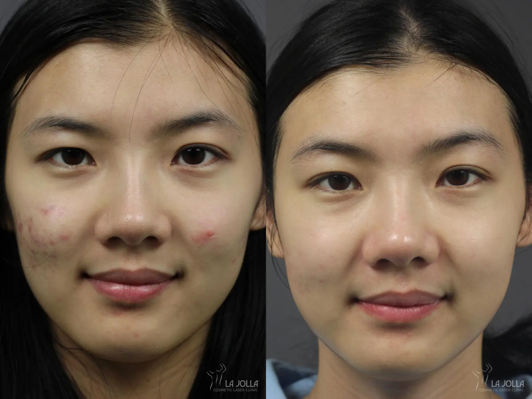 Fraxel®: Patient 7 - Before and After 2