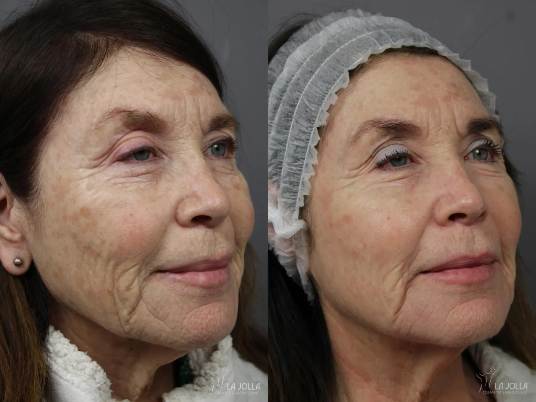 Fraxel®: Patient 1 - Before and After 2