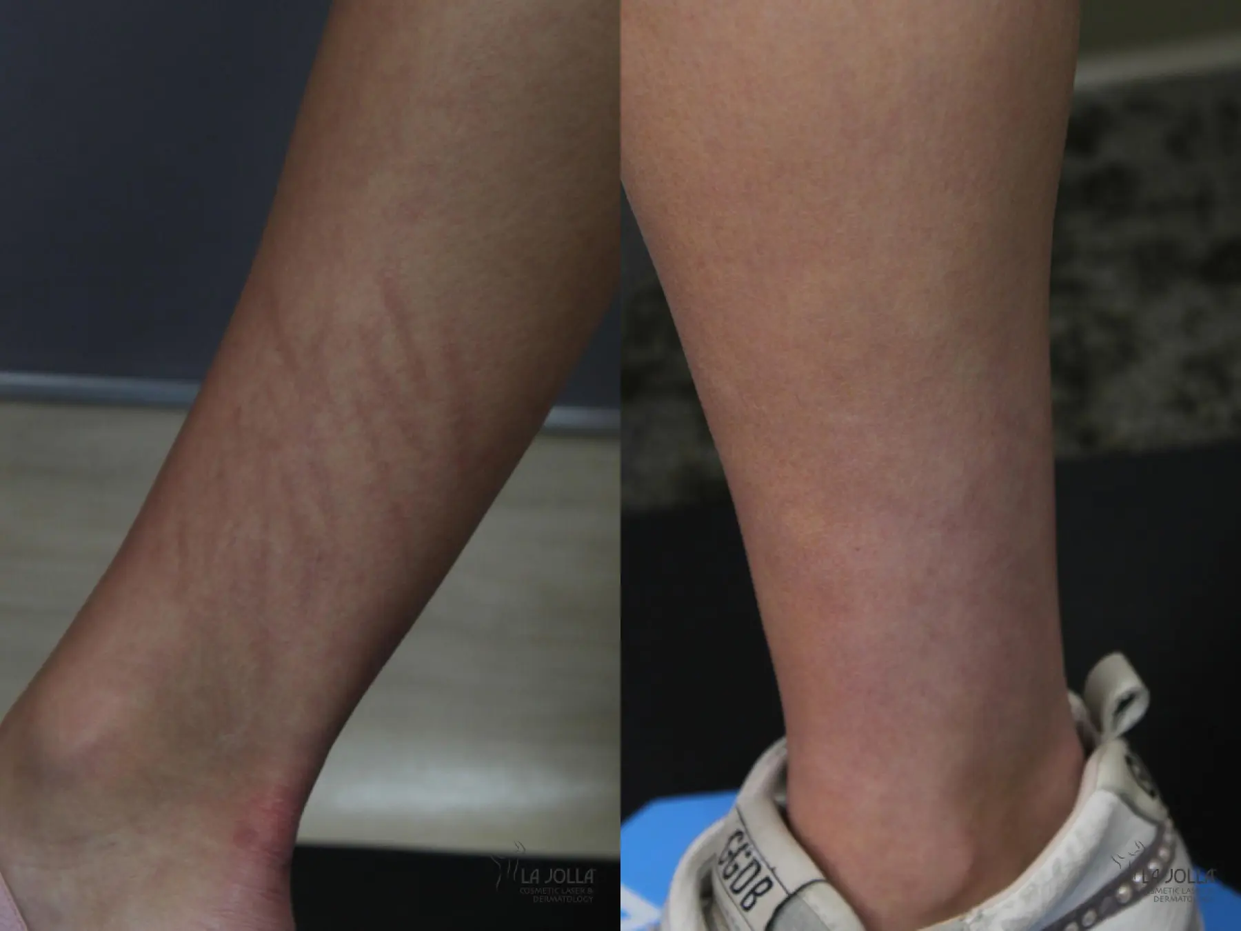 Fraxel®: Patient 1 - Before and After 2