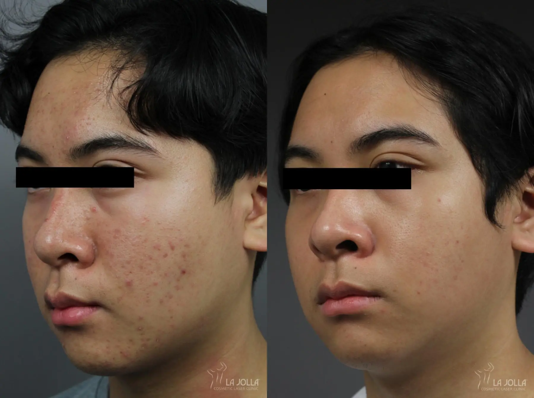 Fraxel®: Patient 14 - Before and After 2