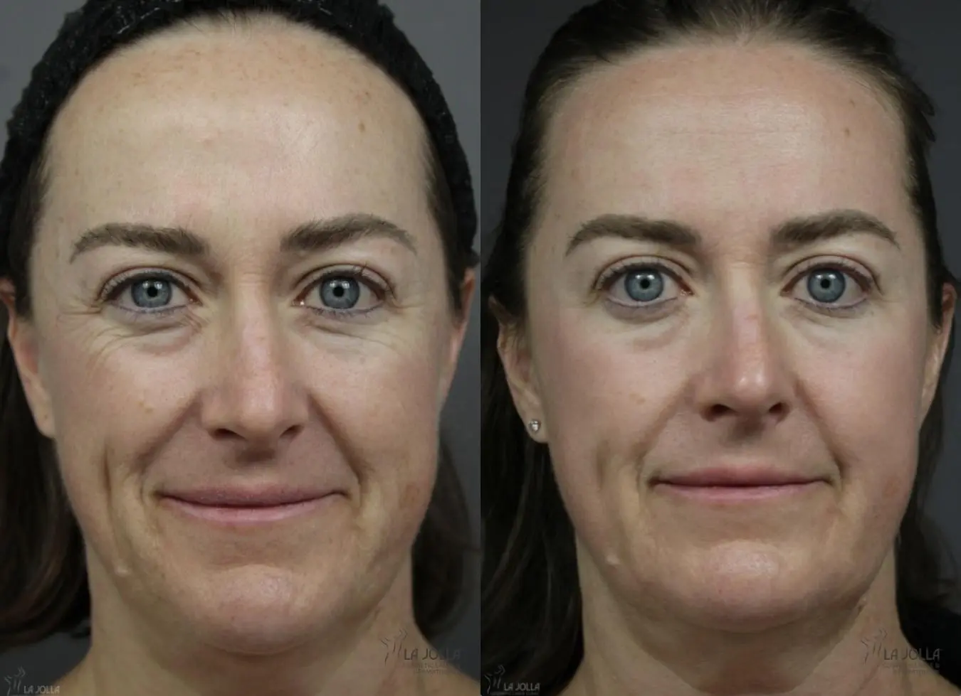 Fraxel®: Patient 2 - Before and After  