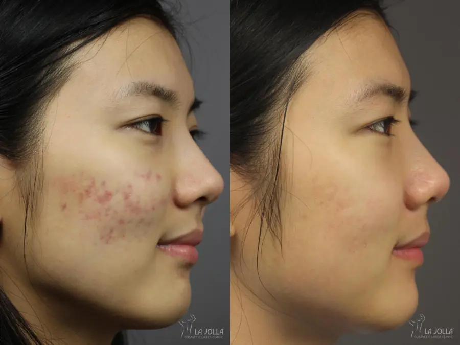 Fraxel®: Patient 1 - Before and After  