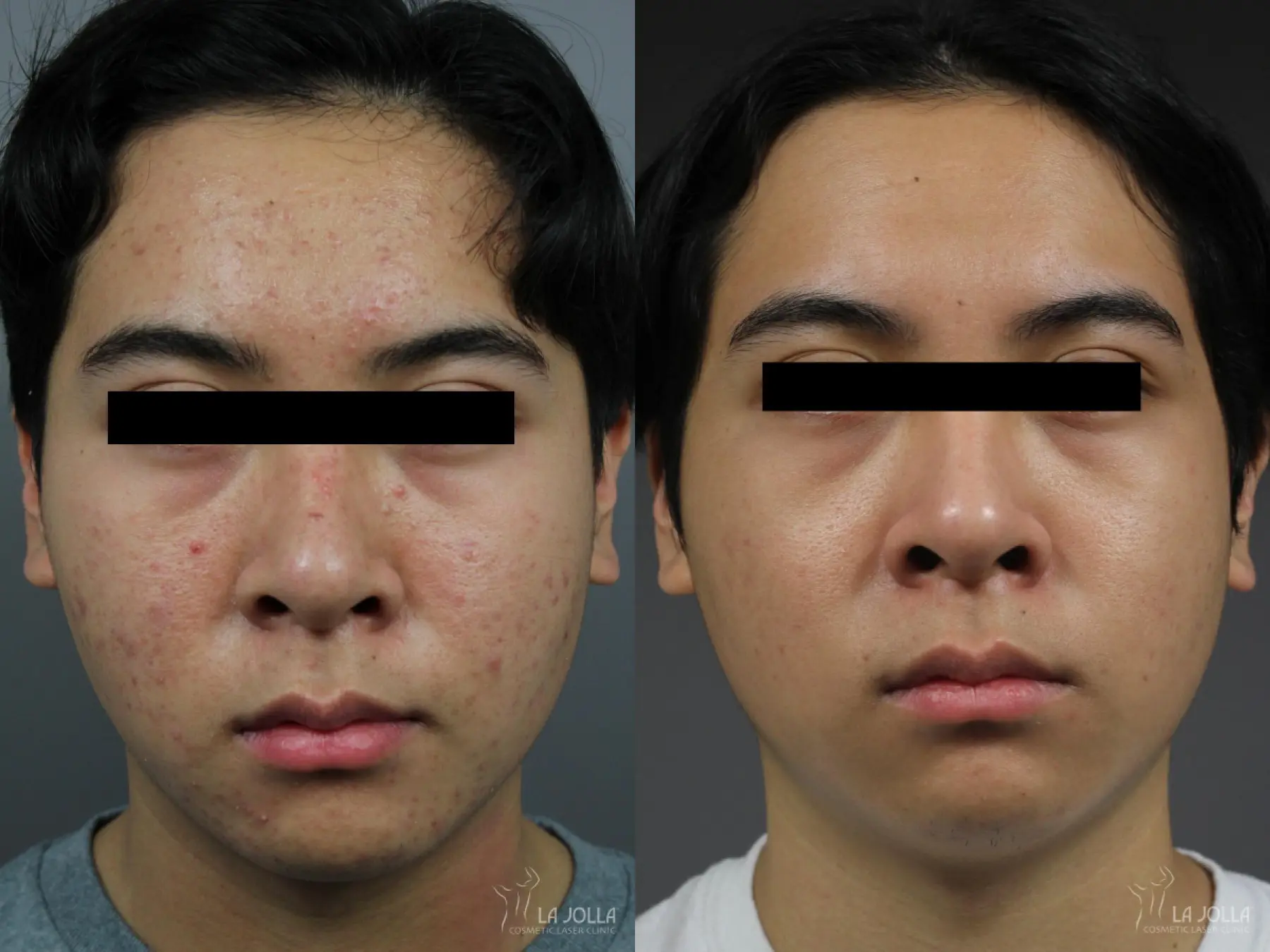 Fraxel®: Patient 14 - Before and After 1