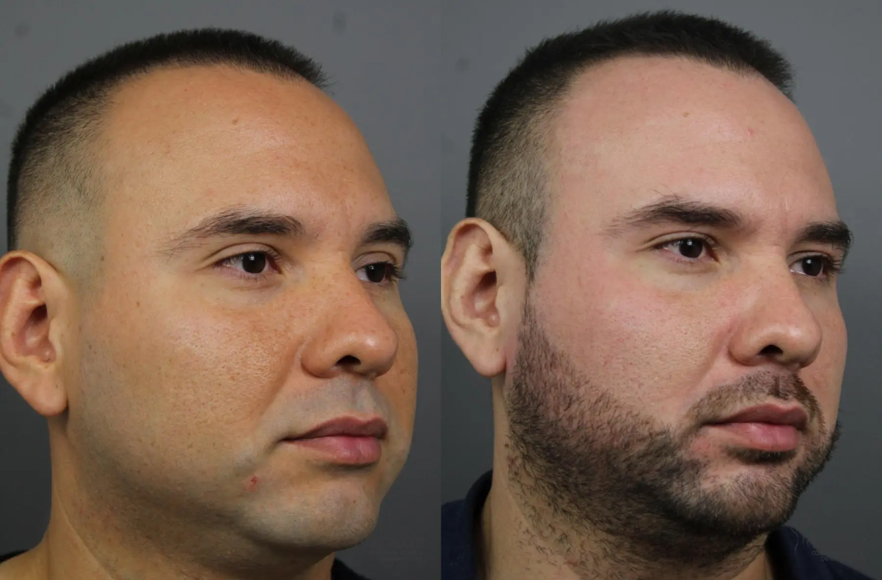 Fraxel®: Patient 3 - Before and After 3