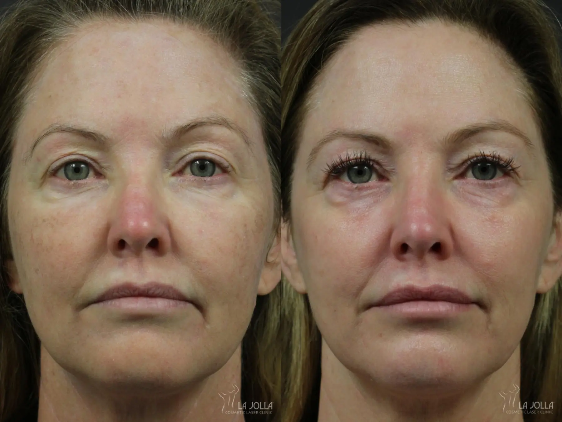 Fraxel®: Patient 9 - Before and After 3