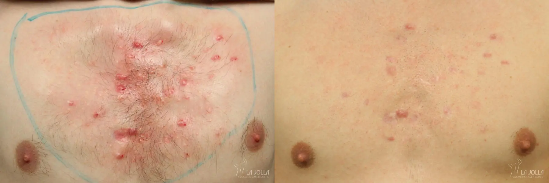 Fraxel®: Patient 2 - Before and After  