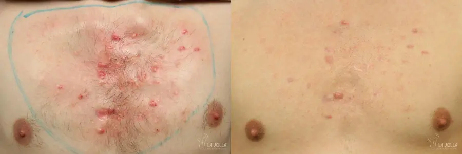 Fraxel®: Patient 2 - Before and After  