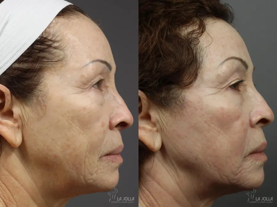 Fraxel®: Patient 8 - Before and After  