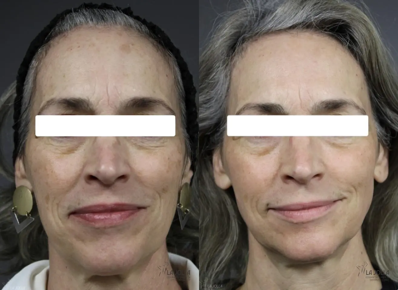 Fraxel®: Patient 1 - Before and After 1