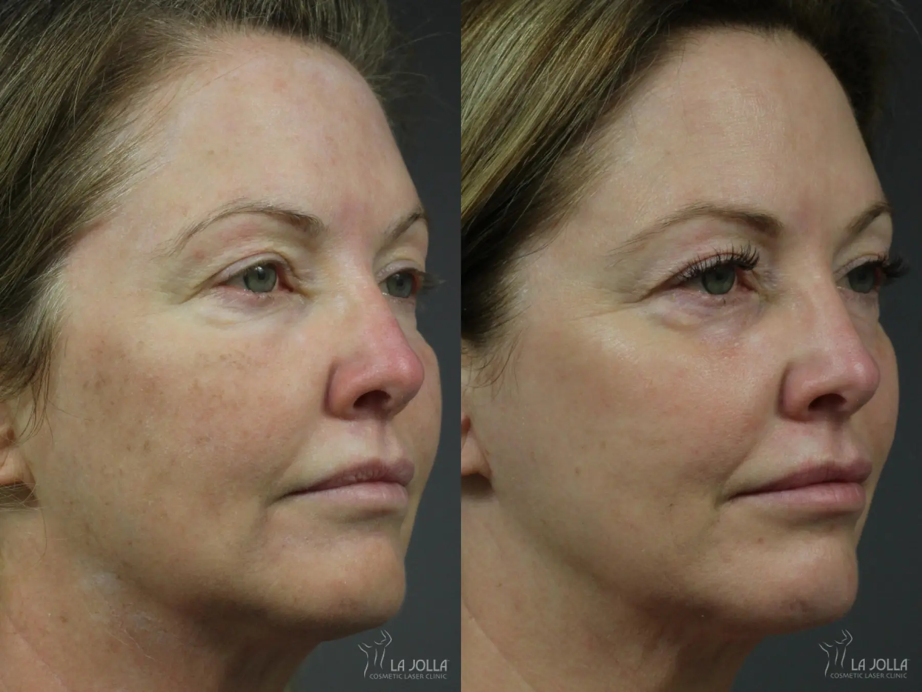 Fraxel®: Patient 9 - Before and After 2