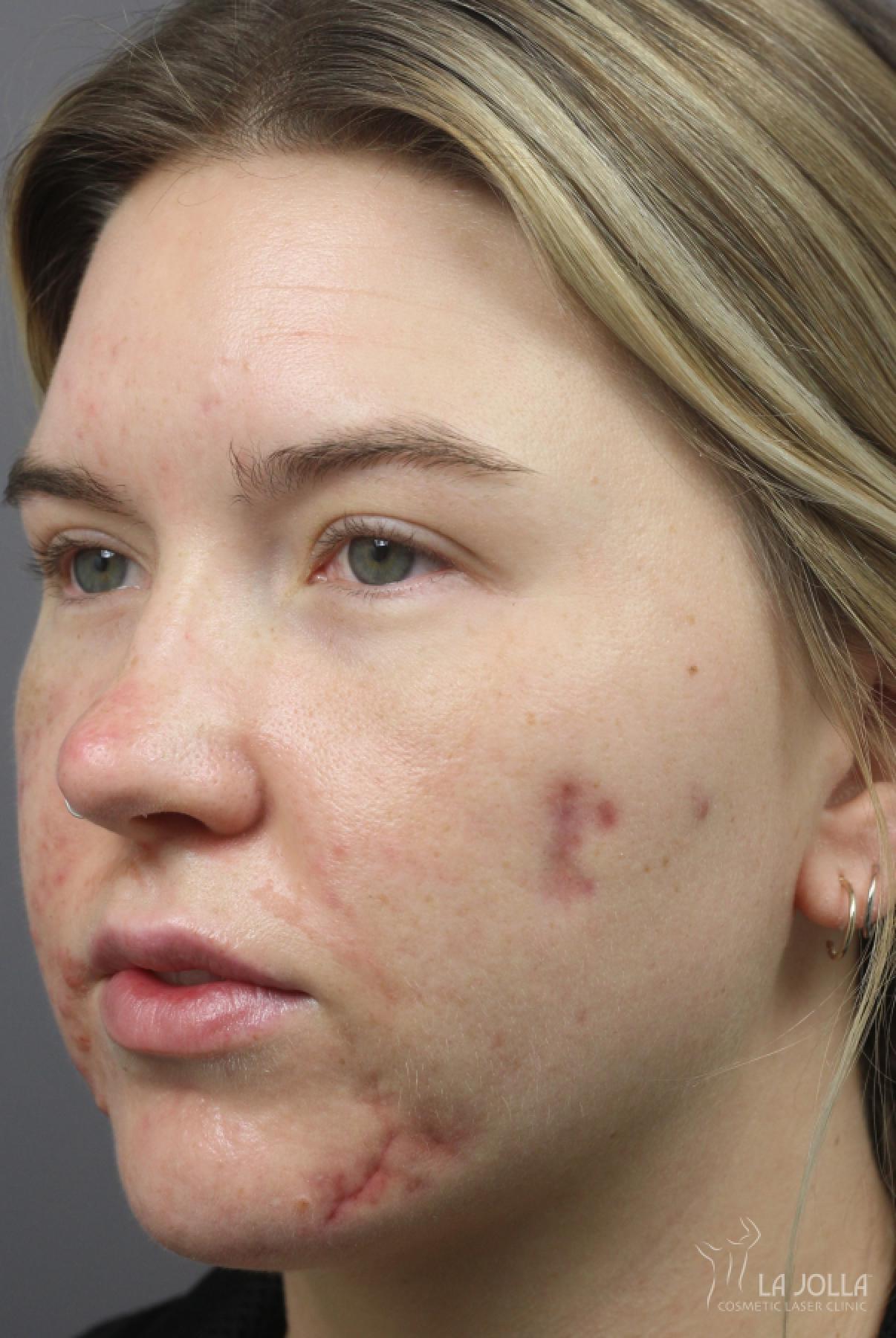 Acne Scars: Patient 2 - Before and After 3