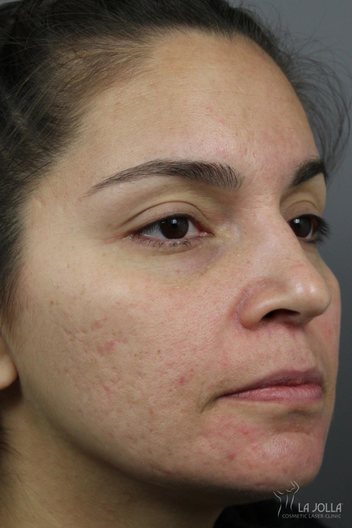 Acne Scars: Patient 3 - Before and After 3
