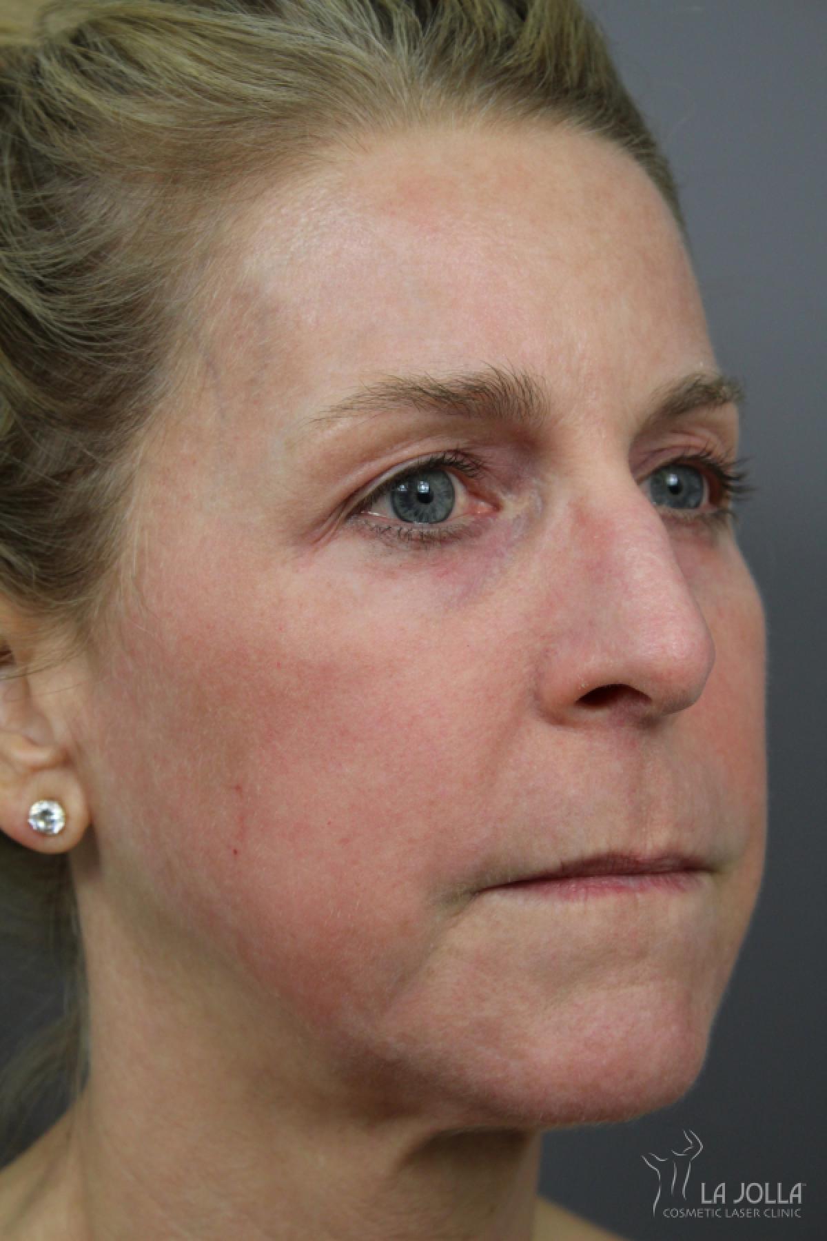CO2 Laser: Patient 16 - After 3