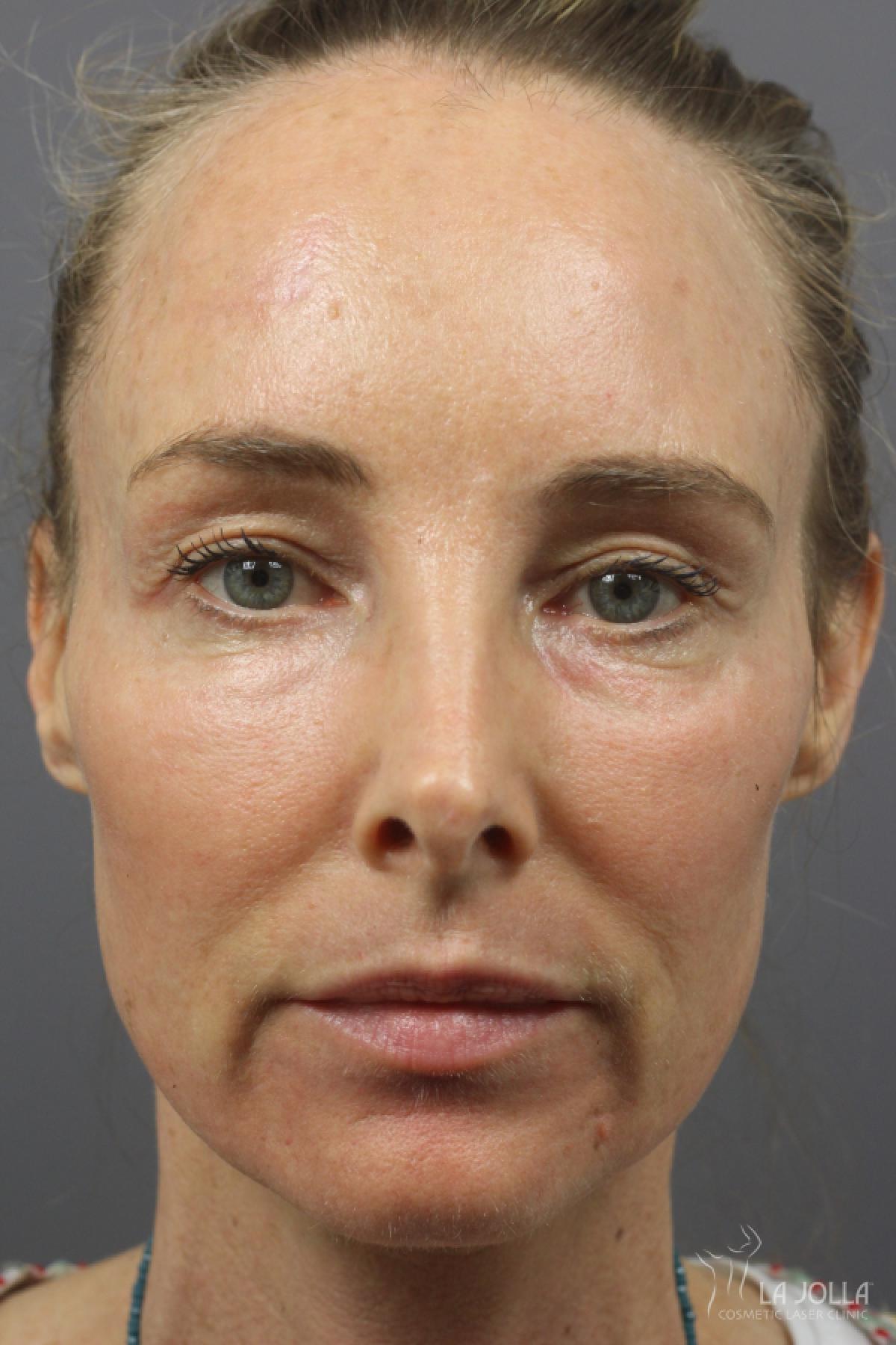 CO2 Laser: Patient 21 - After 1
