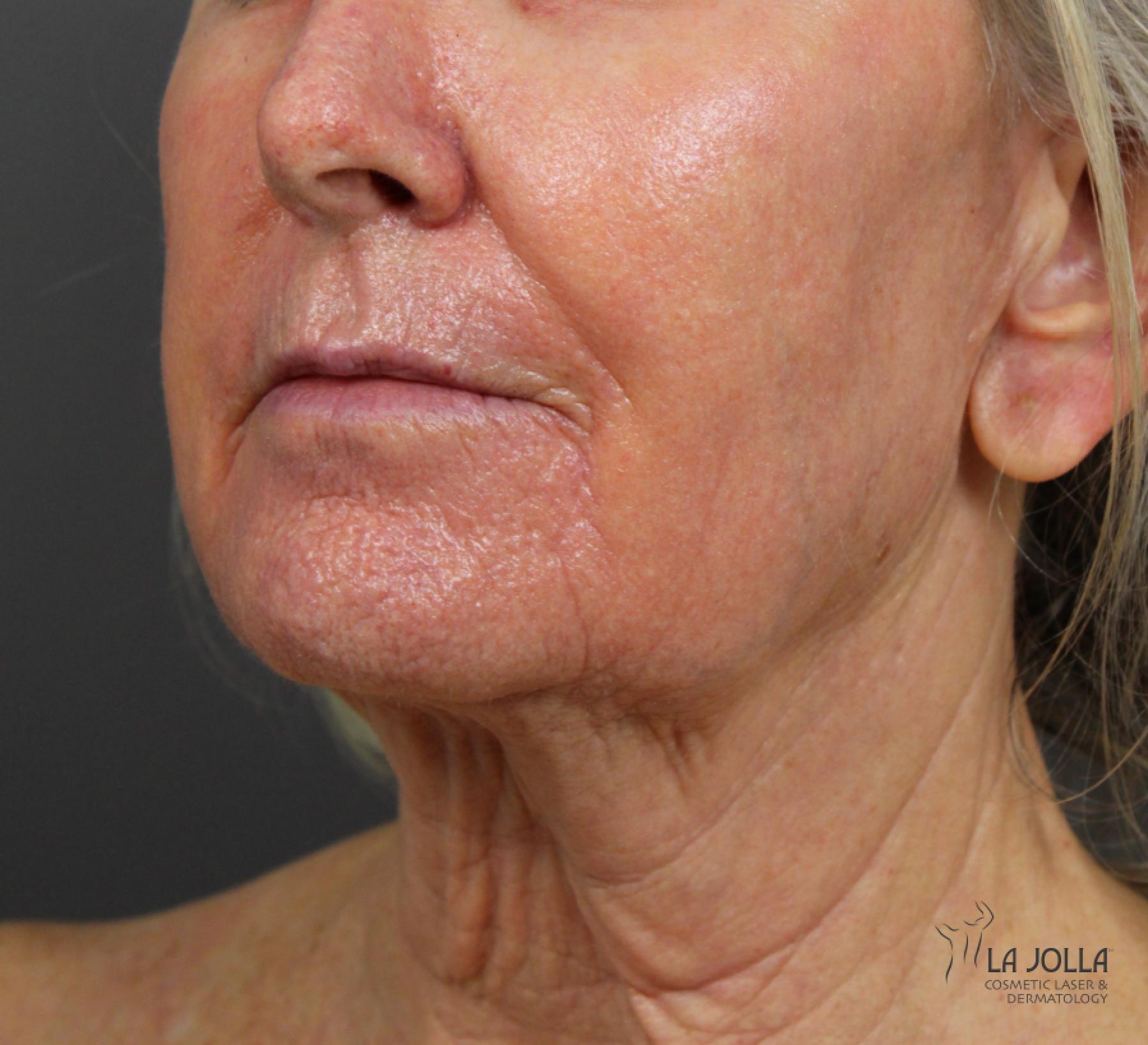 CO2 Laser: Patient 4 - After 2