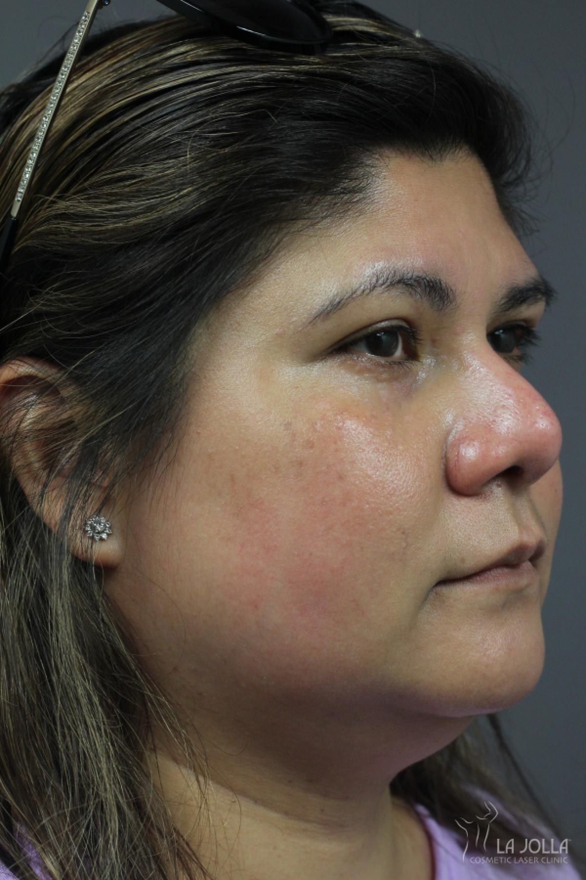 Chemical Peel: Patient 6 - After 2