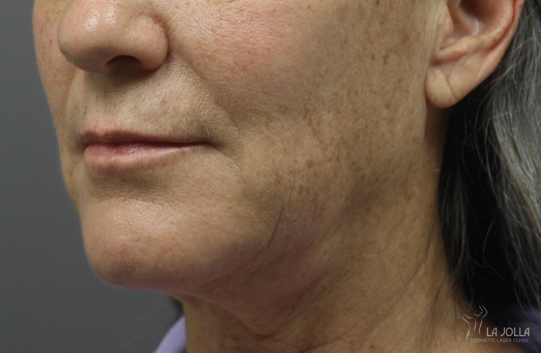 Ultherapy®: Patient 5 - After  