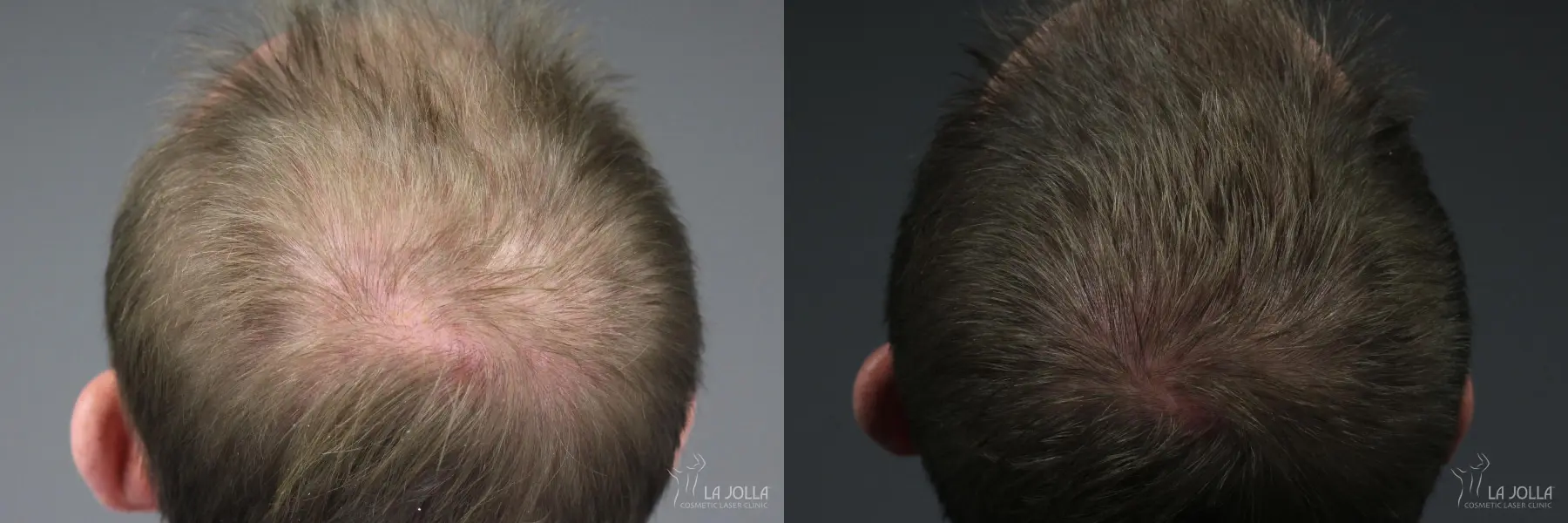 Hair Restoration: Patient 7 - Before and After 2
