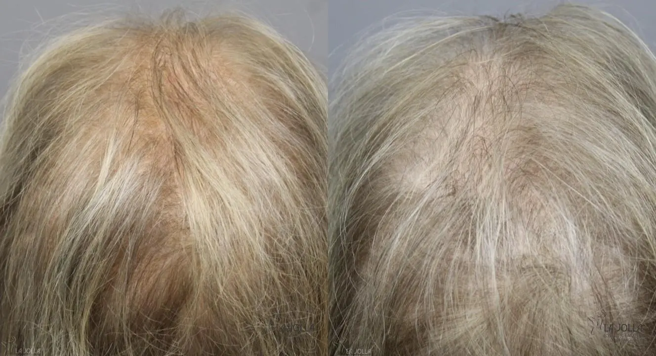 Hair Restoration: Patient 1 - Before and After  
