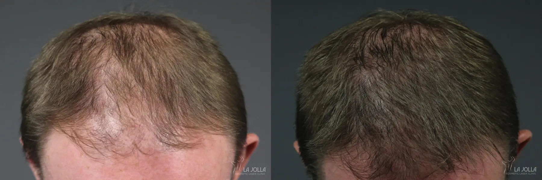 Hair Restoration: Patient 8 - Before and After  