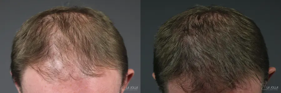 Hair Restoration: Patient 7 - Before and After  