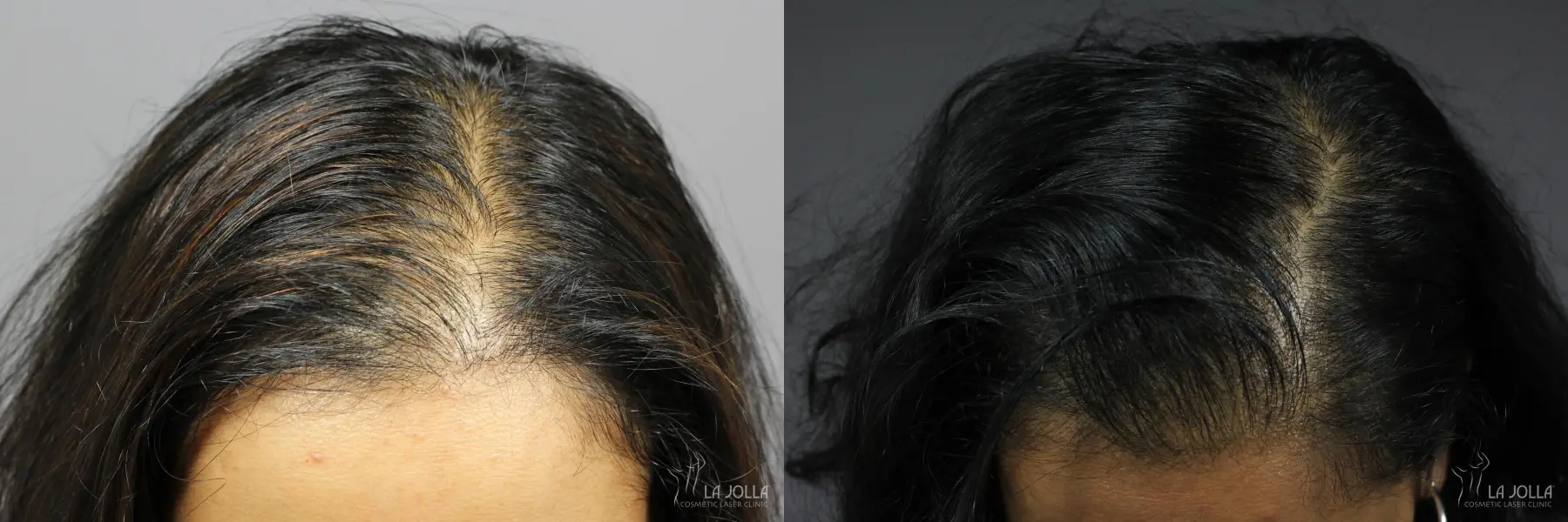 Hair Restoration: Patient 9 - Before and After 1