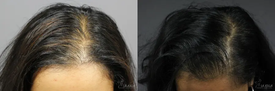 Hair Restoration: Patient 8 - Before and After  