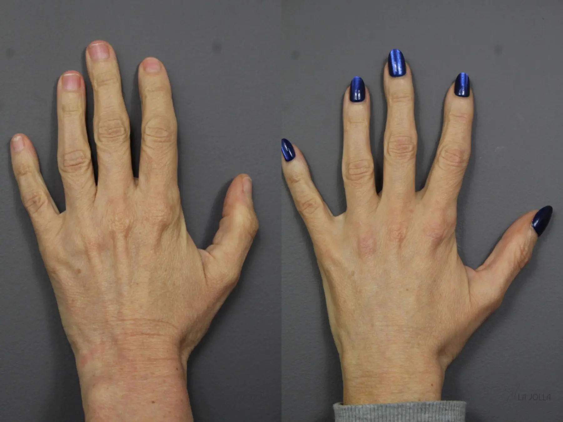 Hand Rejuvenation: Patient 1 - Before and After  