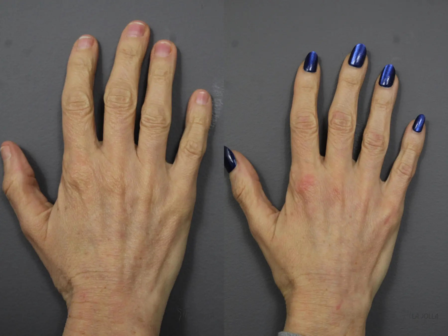 Hand Rejuvenation: Patient 1 - Before and After 2