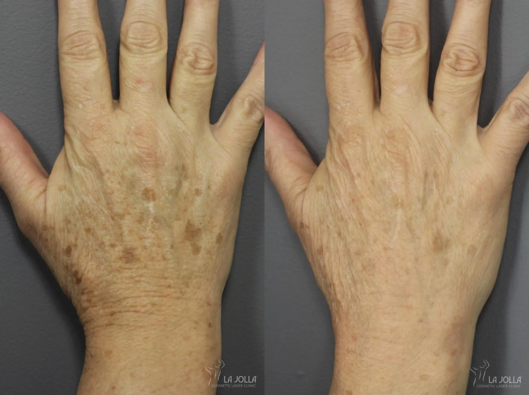 Hand Rejuvenation: Patient 2 - Before and After 1