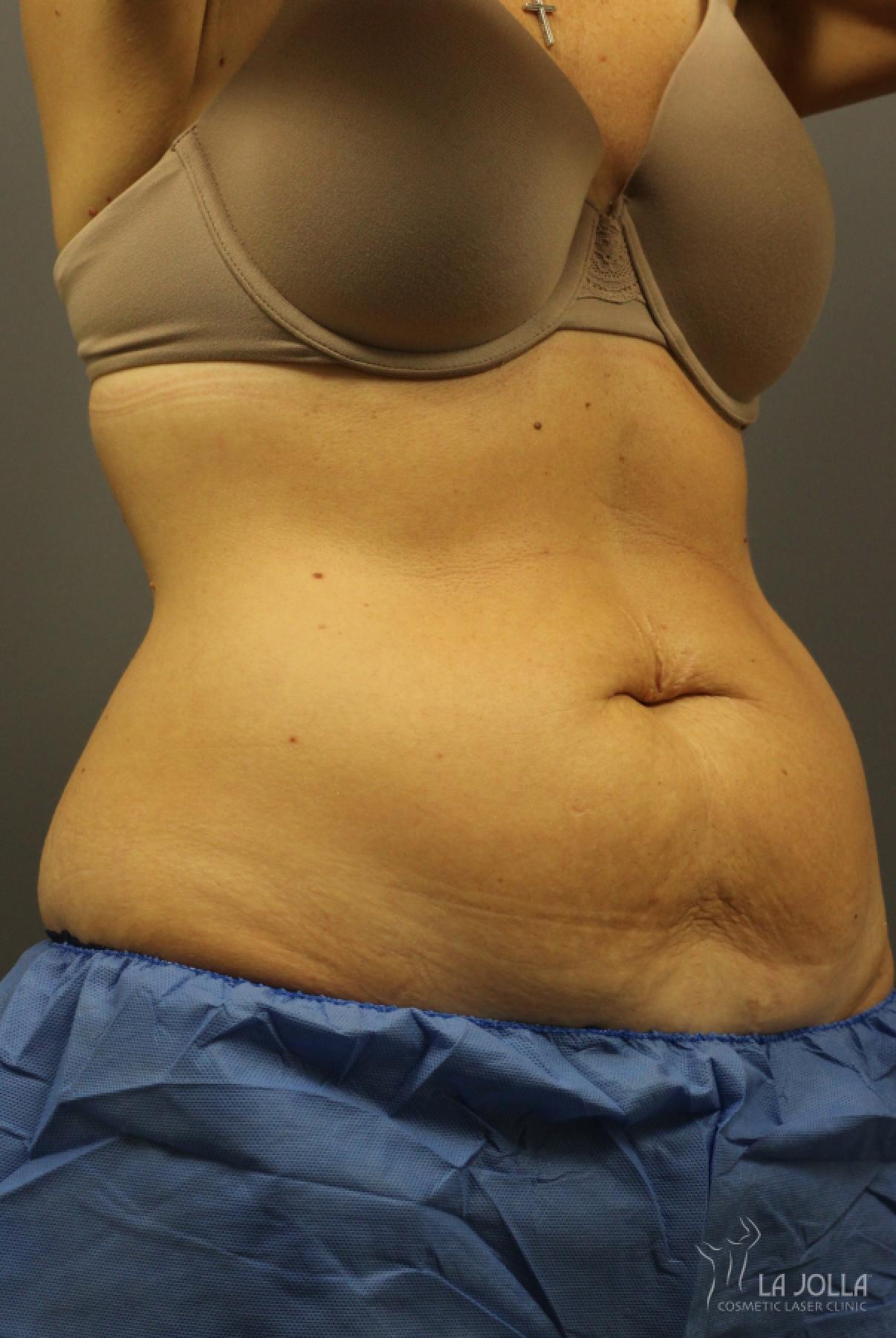 CoolSculpting®: Patient 7 - Before 