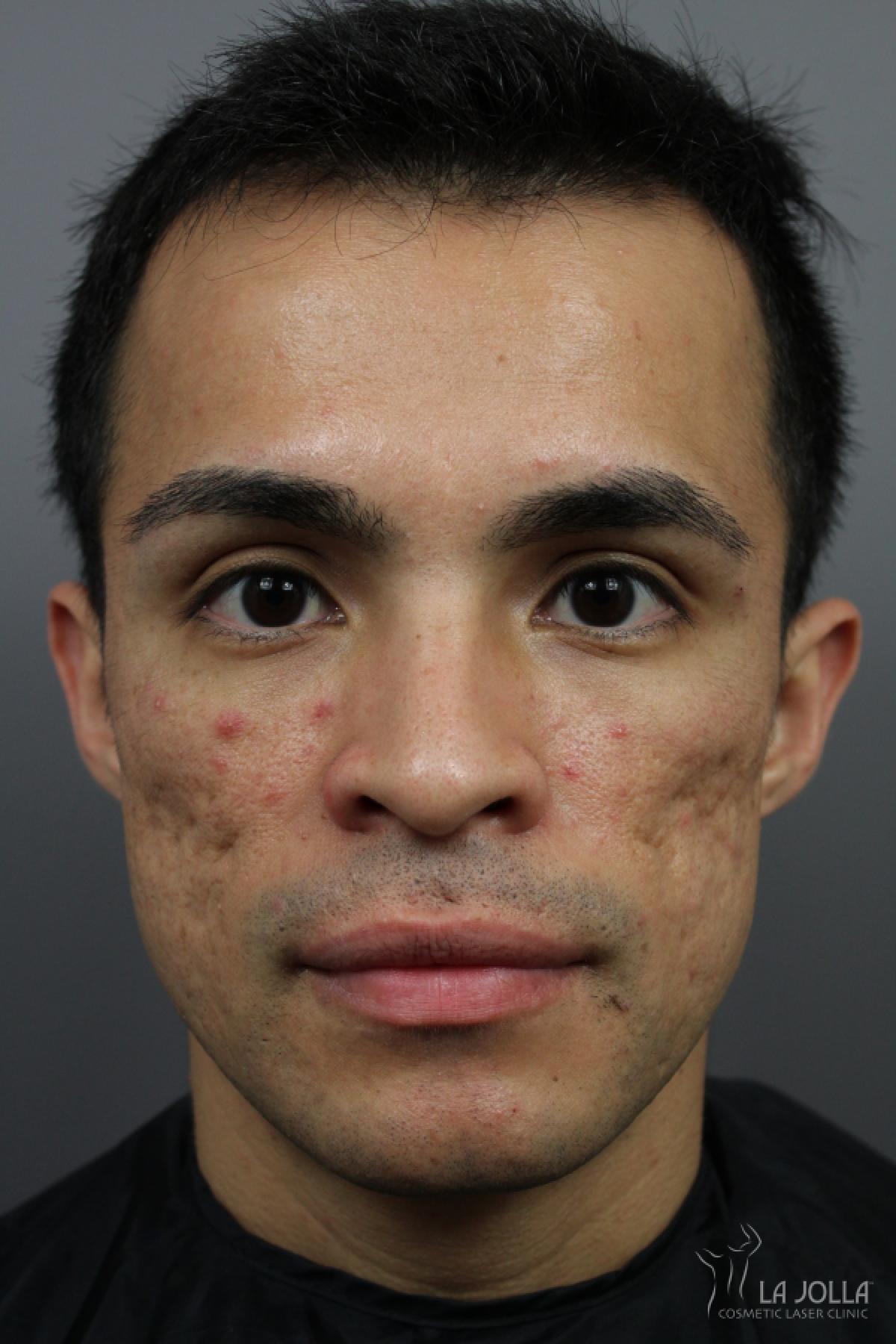 Acne Scars: Patient 4 - Before 2