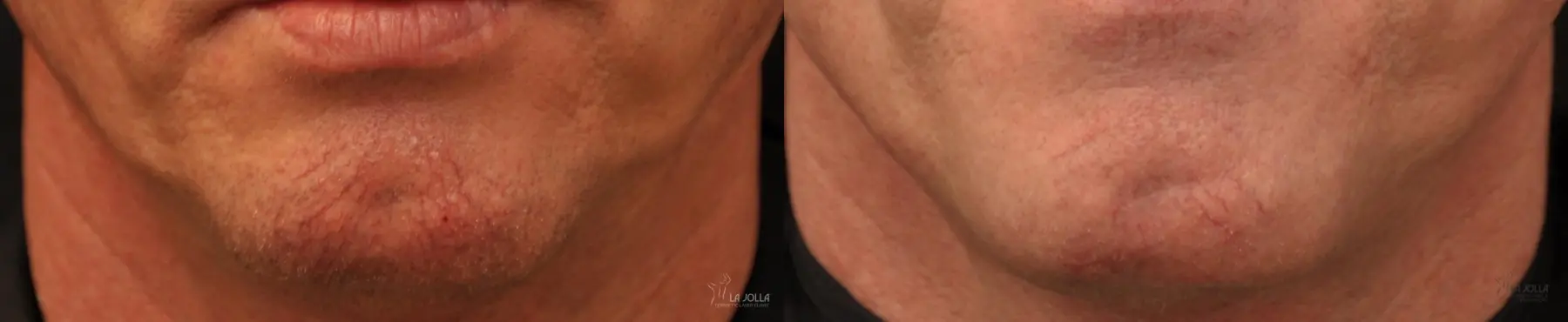 IPL: Patient 5 - Before and After 1