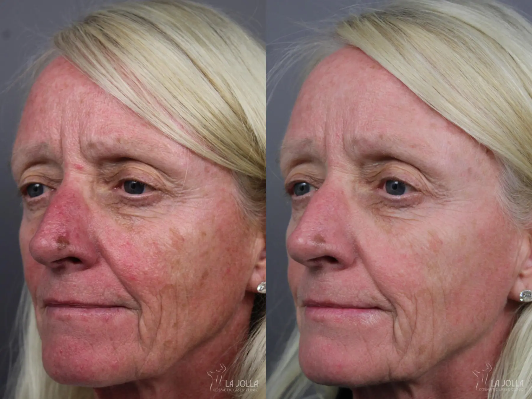 IPL: Patient 12 - Before and After 1
