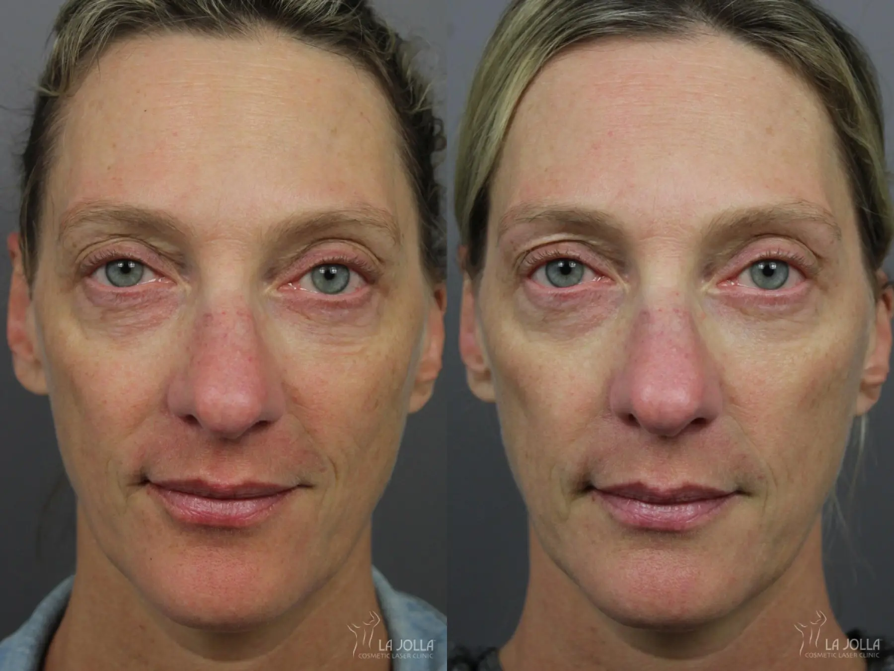 IPL: Patient 11 - Before and After 1