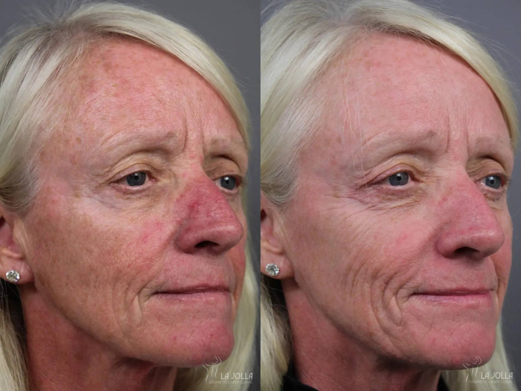 IPL: Patient 12 - Before and After 2