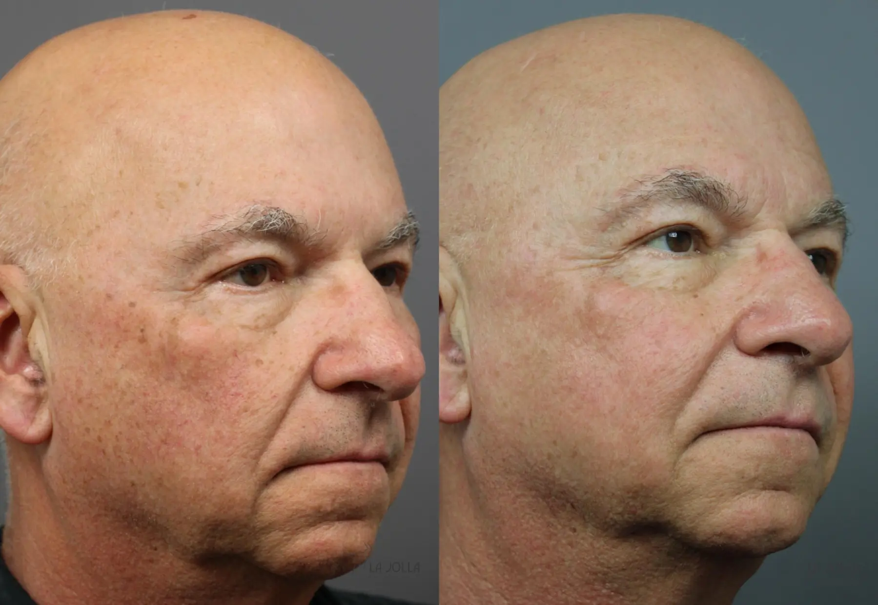 IPL: Patient 1 - Before and After  