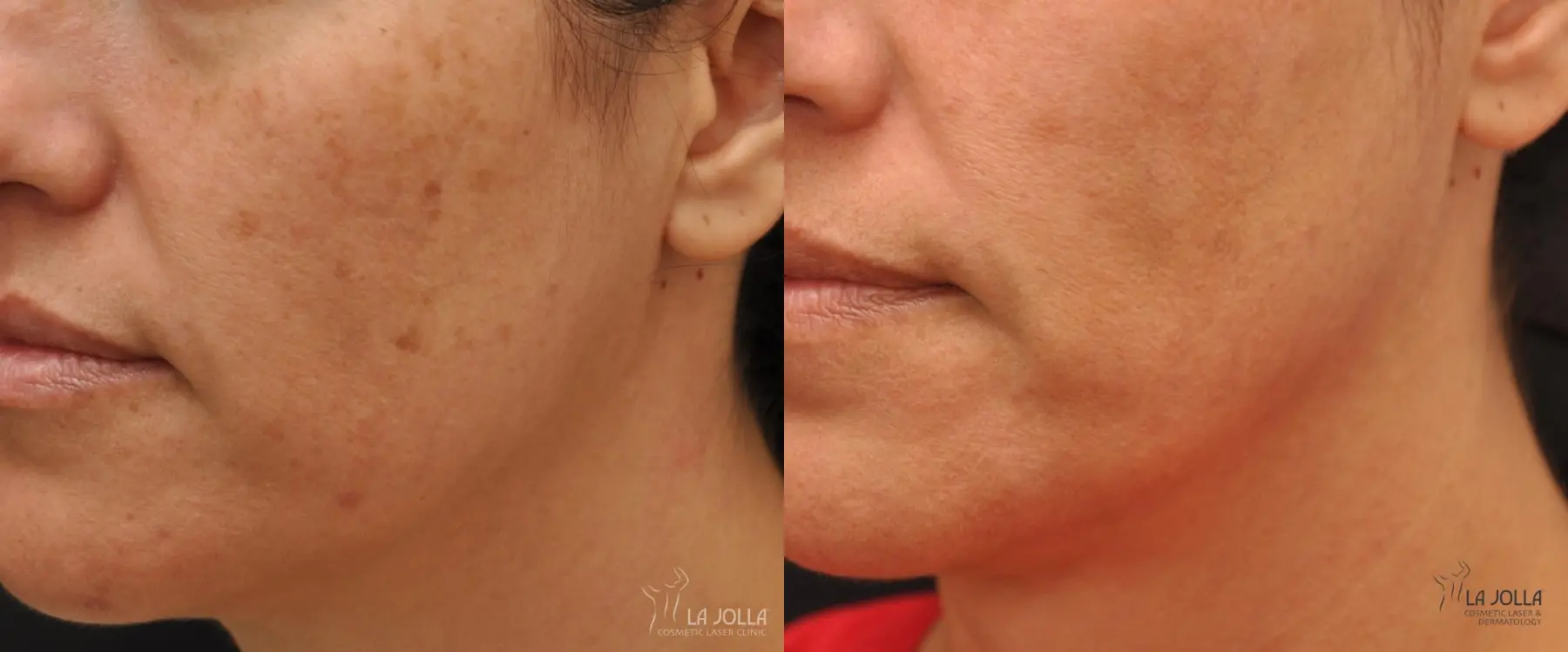 IPL: Patient 8 - Before and After 1